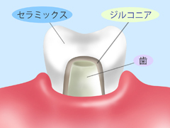 ジルコニアレアリング