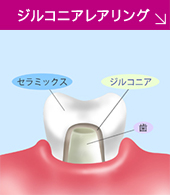 ジルコニアレアリング